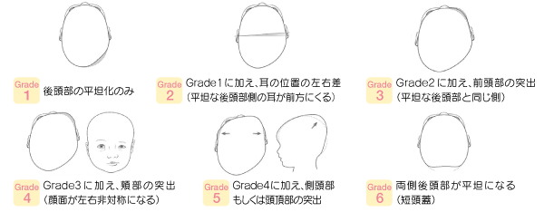 グレード（重症度）の図解